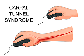 Carpal Tunnel Illustration